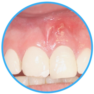 Abscess Tooth abscess tooth image