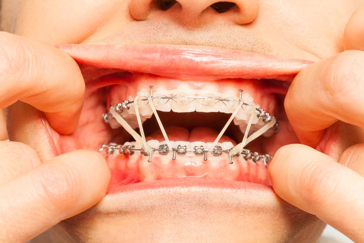 apply a rubber band (elastic)