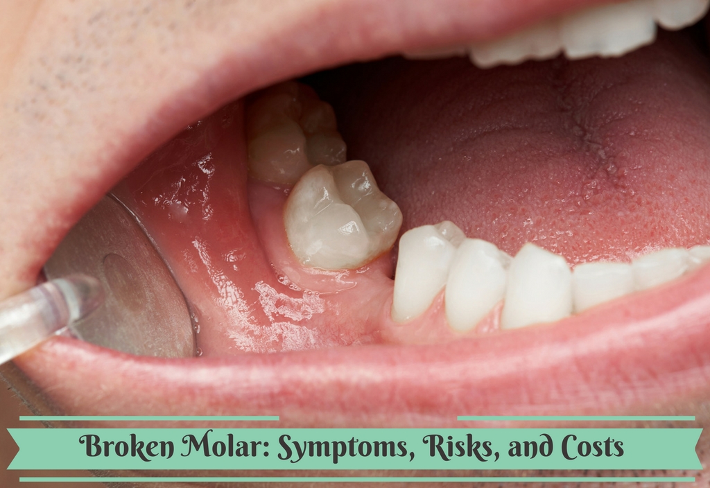 Broken Molar Broken Molar