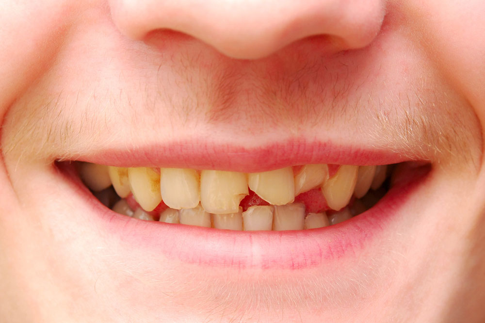 Broken Tooth crown