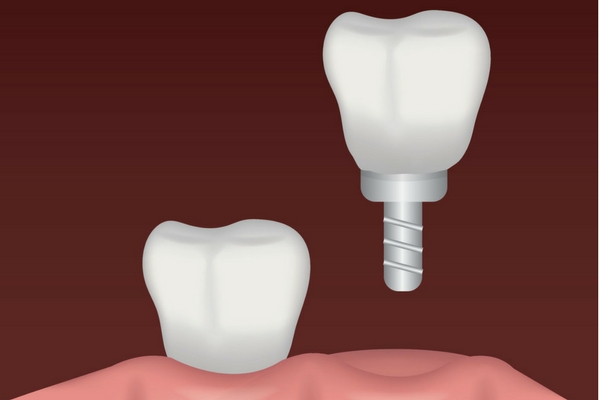 Dental Implant Broken Molar