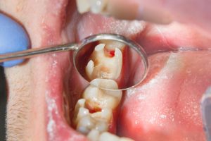How can you have a hole in your tooth