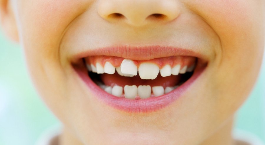 Hyperdontia is when you have extra teeth