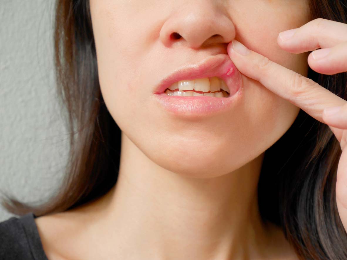 Thrush and How Do You Treat Thrush and How Do You Treat