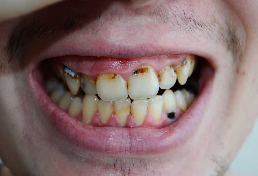 Tooth infection