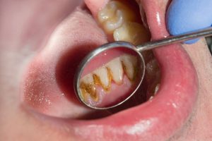 What are the Symptoms of Rotten Teeth