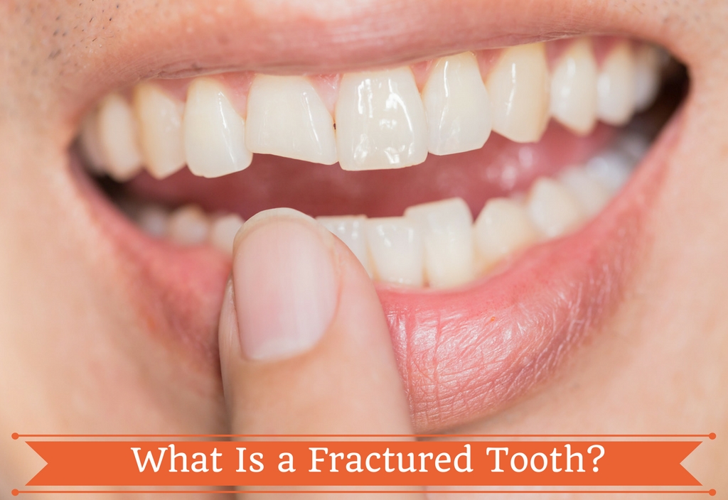 What Is a Fractured Tooth Fractured Tooth