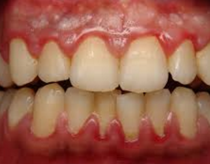 gum disease